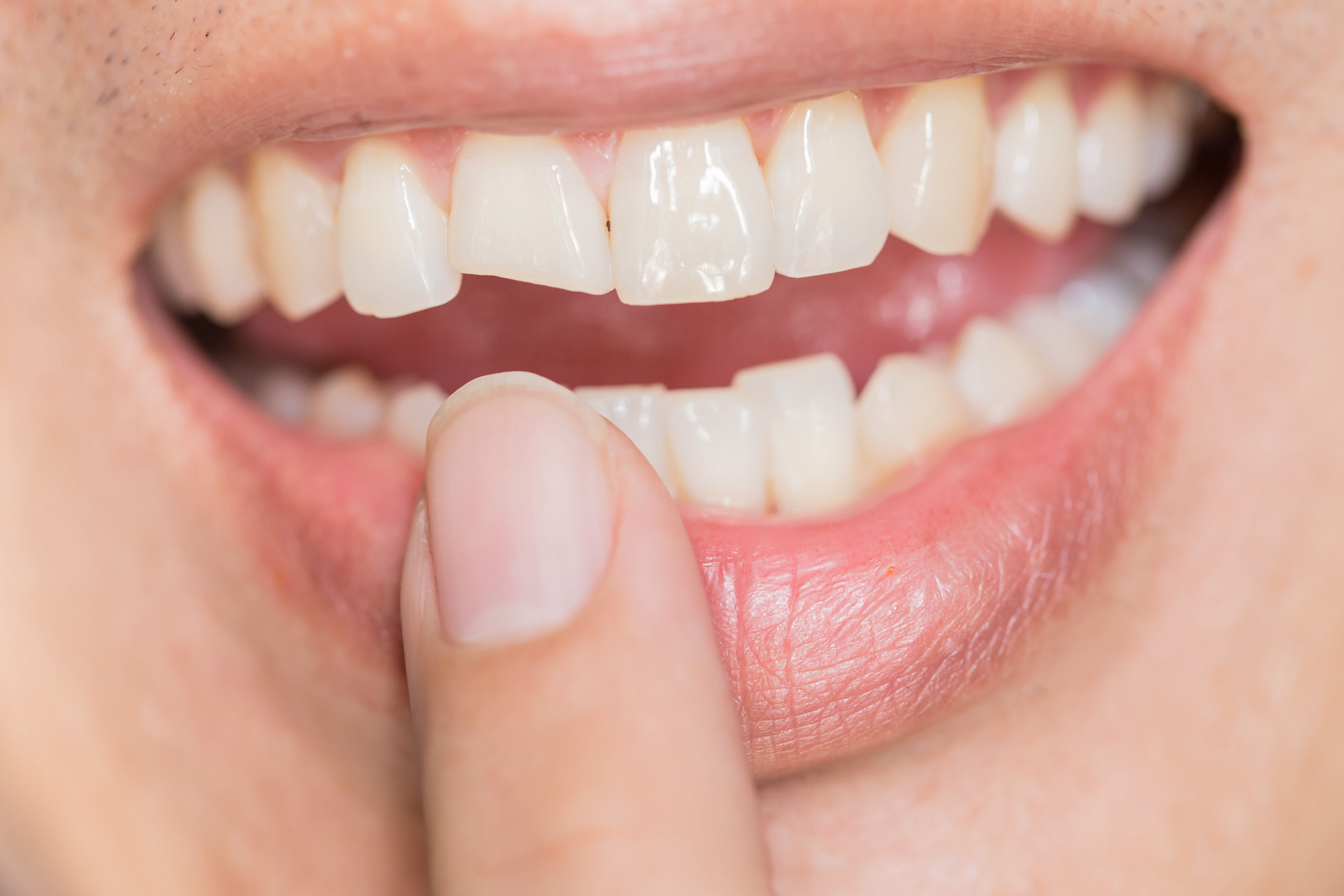 Treatment Options for Cracked or Fractured Teeth