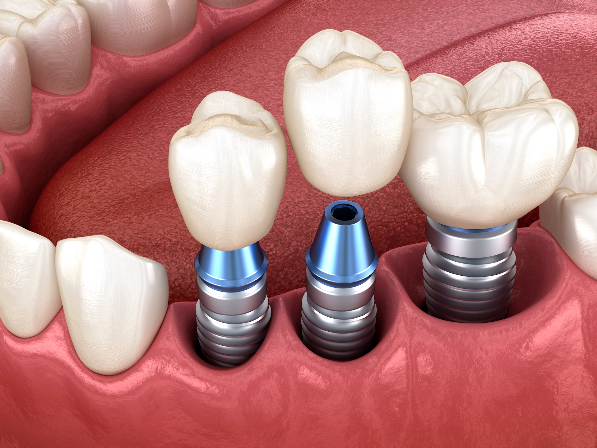 3 Signs You May Need Dental Crowns