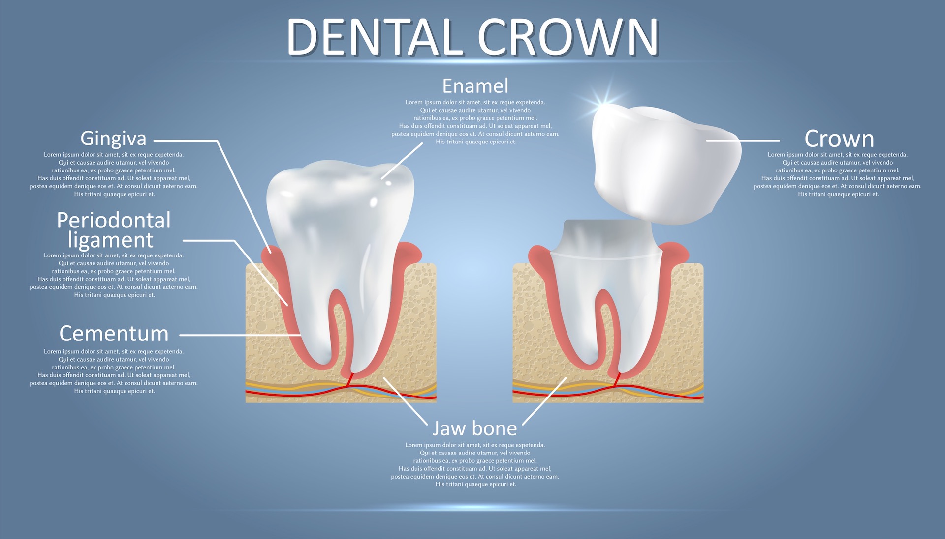 What to Expect With a Dental Crown Restoration