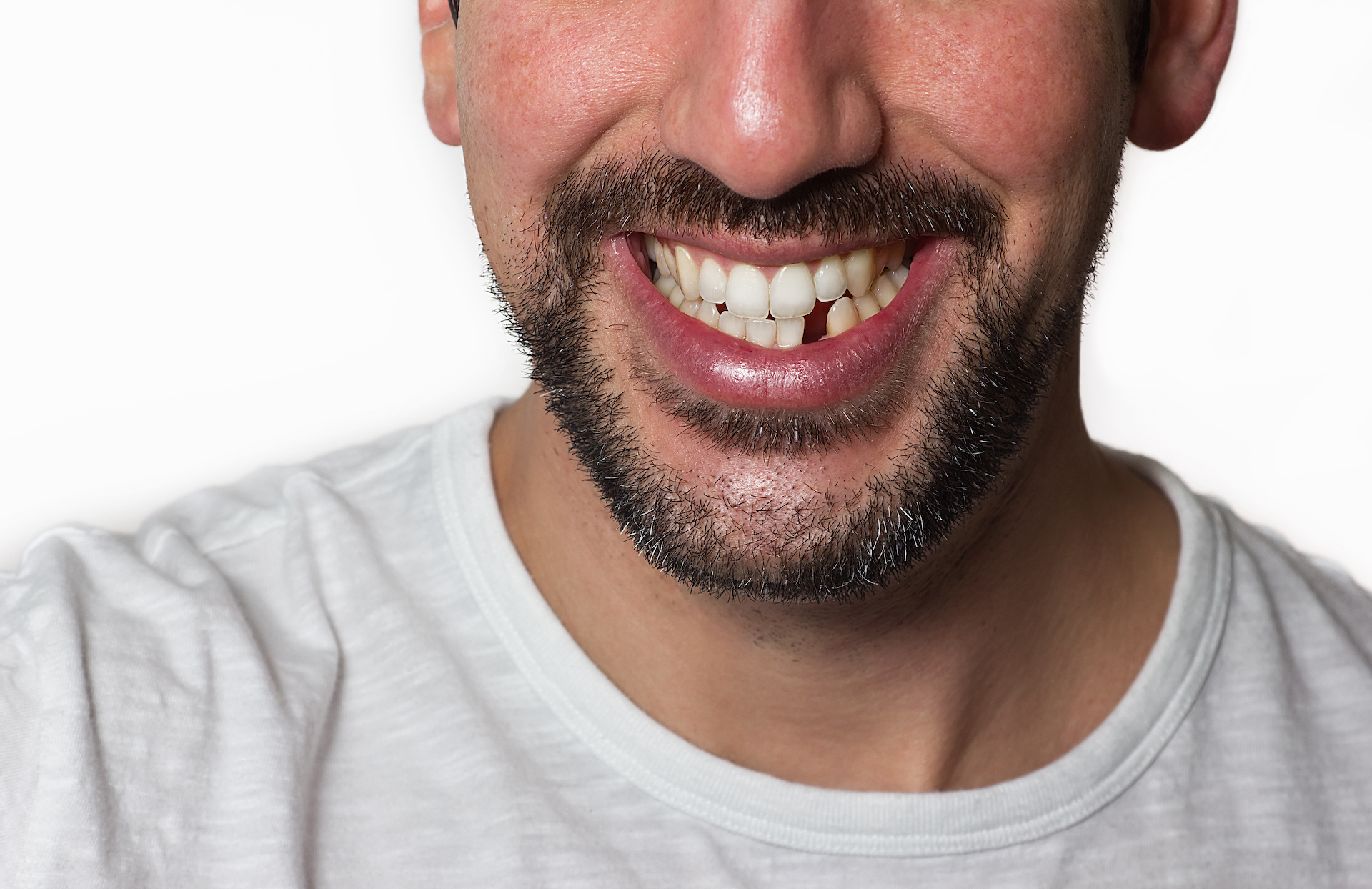 Do I Need a Dental Implant?