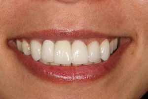 Dental Implants After