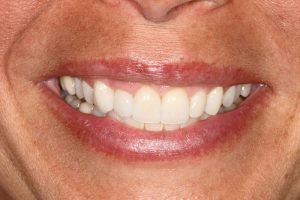 After Veneers