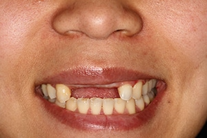 Dental Implants Before