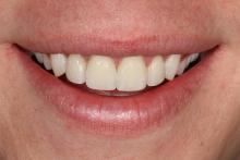 After Veneers